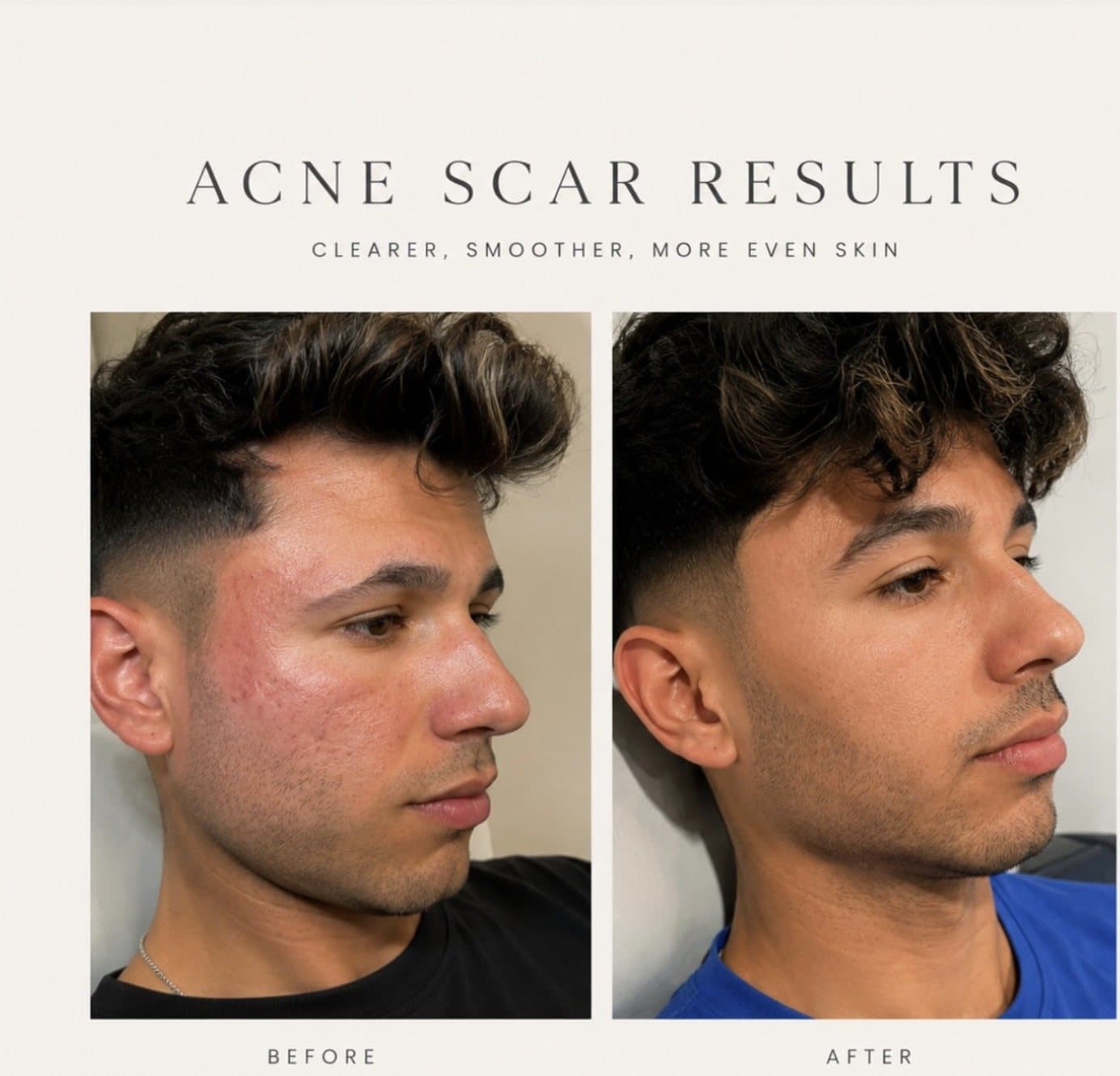 Acne scar treatment before and after: clearer, smoother, more even skin